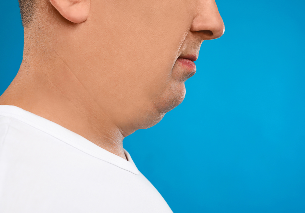 Lipo de papada masculina